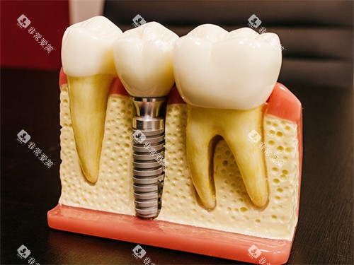 种植牙模型图