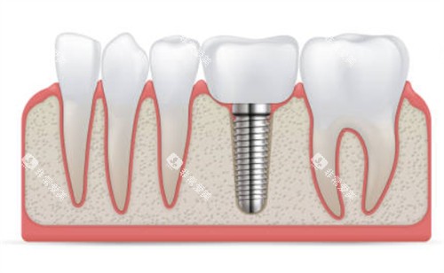 种植牙和临牙示意图