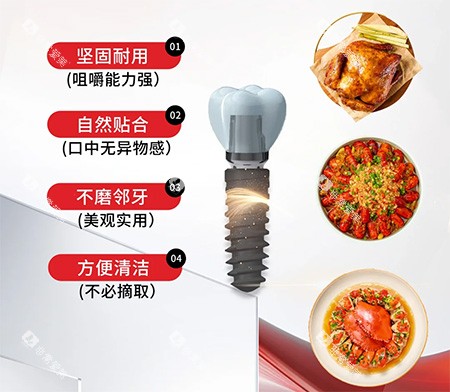 安特种植牙特色优点