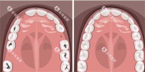 牙齿缺失补牙示意图
