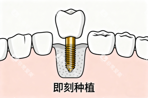 牙齿即刻种植卡通图