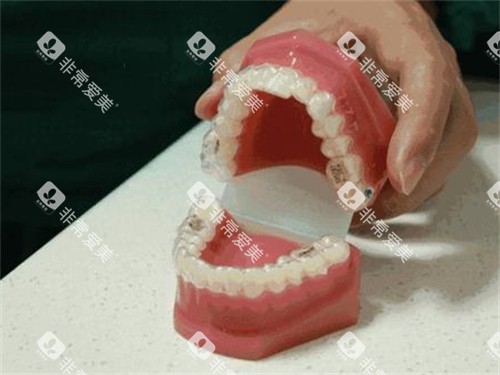 牙齿矫正隐形牙套模型展示示意图 牙齿矫正隐形牙套模型展示示意图