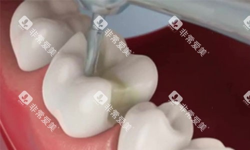 嵌体补牙过程 嵌体补牙过程