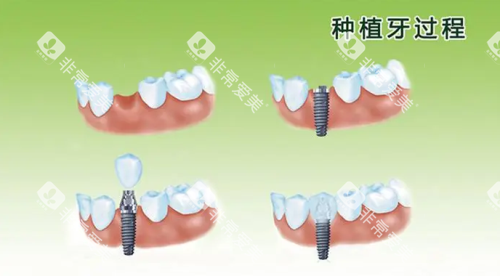 种植牙过程图片