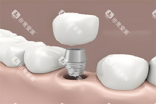 种植牙图片展示图片 种植牙图片展示图片