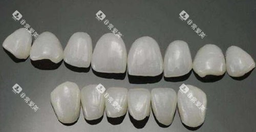 瓷贴面修复改善