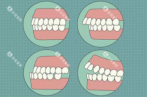 需要牙齿矫正的问题示意图 需要牙齿矫正的问题示意图