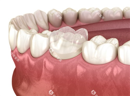 牙齿全瓷冠 牙齿全瓷冠