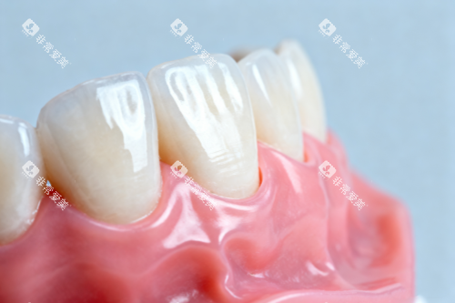 全瓷牙模型图 全瓷牙模型图