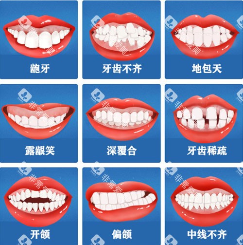 牙齿矫正适应症