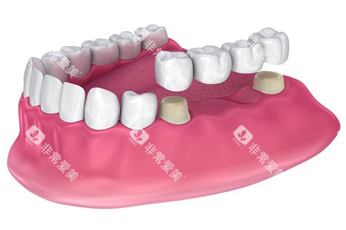 全瓷牙冠义齿修复示意图