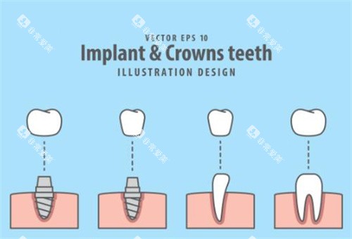 牙齿种植过程图示意图