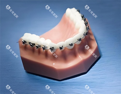 牙齿矫正模型展示图片