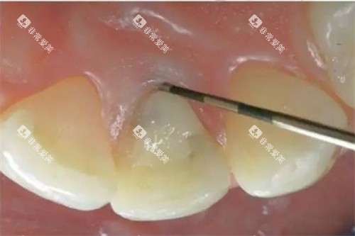 畸形舌侧窝牙齿实例 畸形舌侧窝牙齿实例