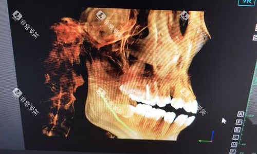 金华东阳马爽口腔牙齿拍片示意图 金华东阳马爽口腔牙齿拍片示意图