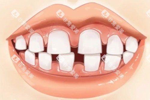 牙齿牙缝大 牙齿牙缝大