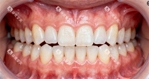 牙齿整齐图片 牙齿整齐图片