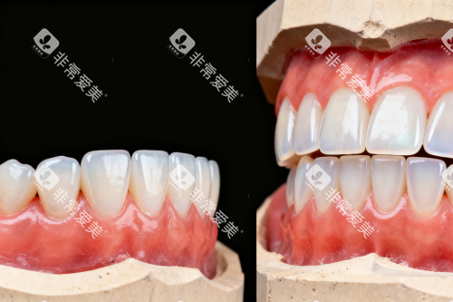 牙齿贴面前后对比图 牙齿贴面前后对比图
