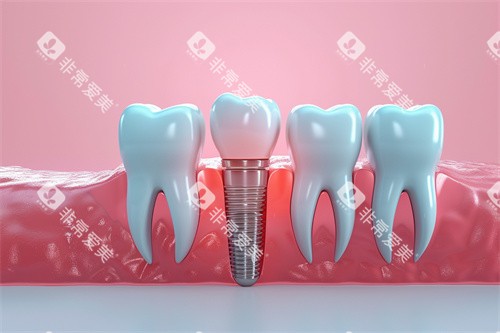 种植牙漫画模型解剖图