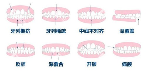 牙齿矫正正畸适应症