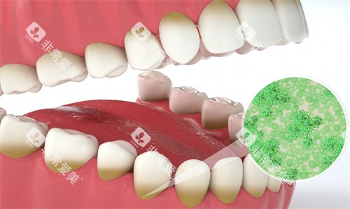 牙齿上会存在的细菌