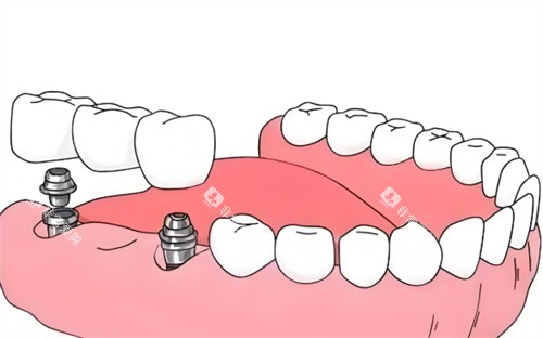 种植牙材料卡通展示图