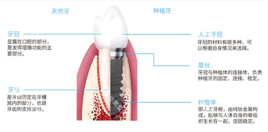 种植牙结构分析图片