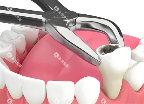 拔牙动画展示图