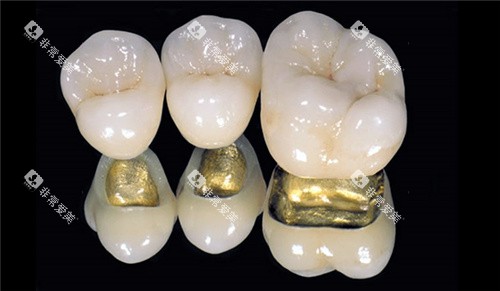 烤瓷牙三颗素材图片