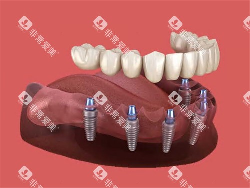 半口种植牙动画示意图展示 半口种植牙动画示意图展示