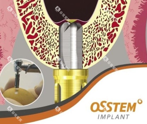 奥齿泰种植牙材料好不好