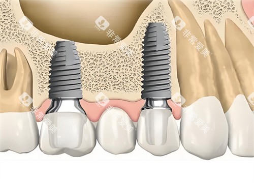 种植牙解剖图片