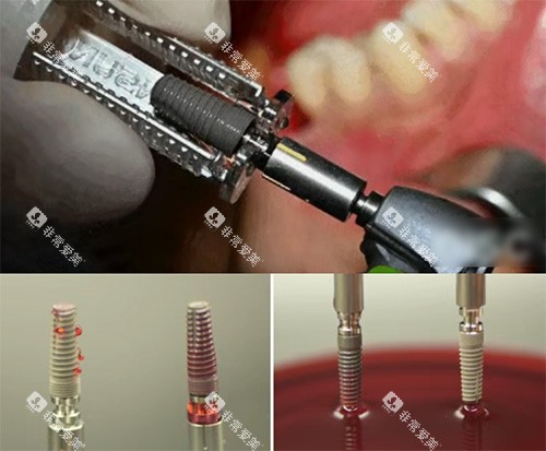 康盛种植牙照片