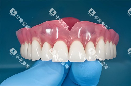 全口种植牙齿图片