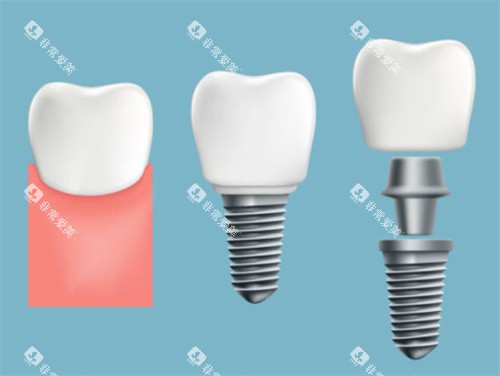 牙齿种植过程图