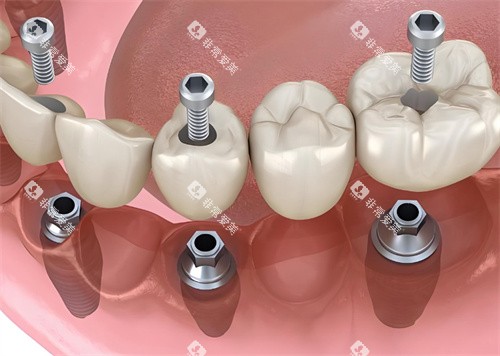 牙齿种植牙模型