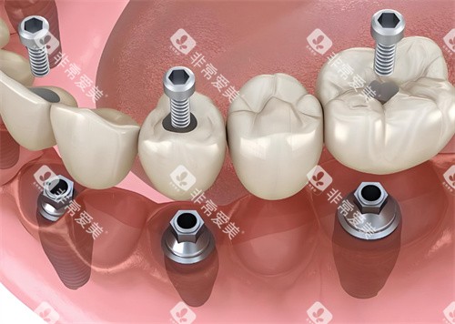 牙齿种植牙模型