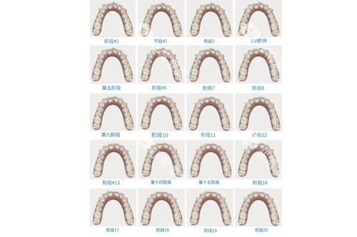 牙齿矫正变化图片
