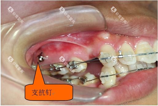 牙齿矫正骨钉种植钉口腔示意图