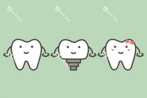 单颗种植牙卡通展示图