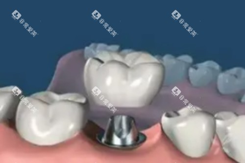 单颗种植牙卡通图片展示