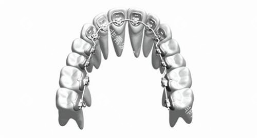 牙齿矫正舌侧矫正牙套概念透视图