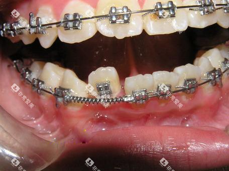 牙齿矫正正畸推簧口内展示图