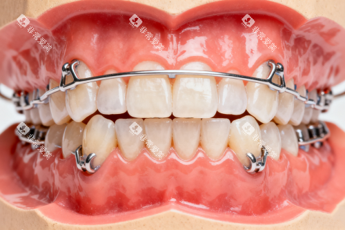 牙齿保持器模型展示图