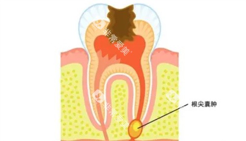 什么是根尖囊肿