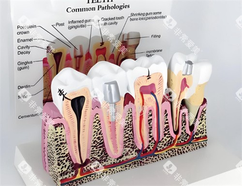 牙齿模型解剖图片