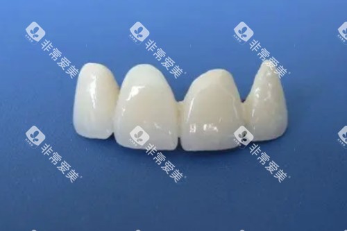 全瓷牙模型展示图