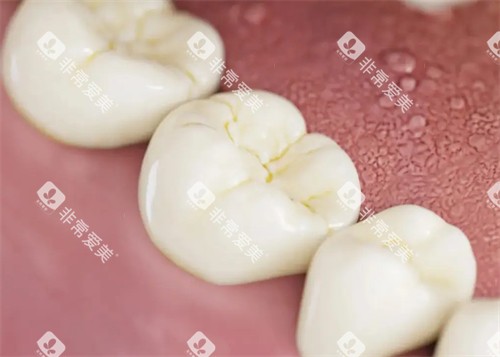 没有正确刷牙的牙齿