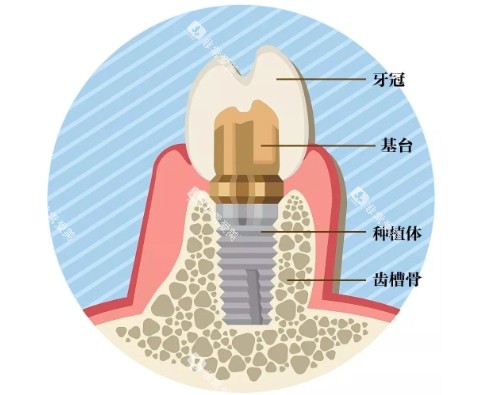 种植牙组成展示图