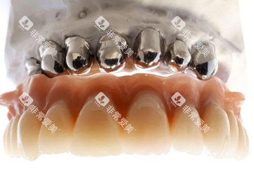 套筒冠义齿示意图